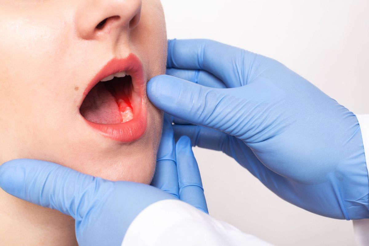 Gusi Berdarah: Penyebab, Dampak, dan Cara Mengatasinya Secara Efektif